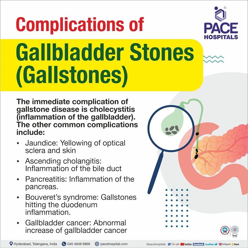 Gallstones Gallbladder Stones Symptoms Causes Complications